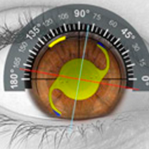 Hoya Toric Calculator